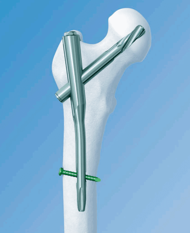 SHORT -PROXIMAL FEMORAL ROTATIONAL STABILITY NAIL(PFRN)