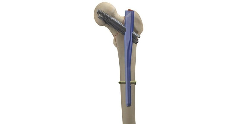 Long Proximal Femoral Integrated Screw Nail, 130°