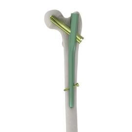 Short - Proximal Femoral Integrated Screw Nail (PFIN ) ,130